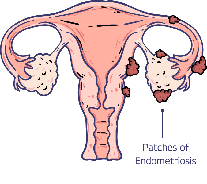 Patches of Endometriosis diagram